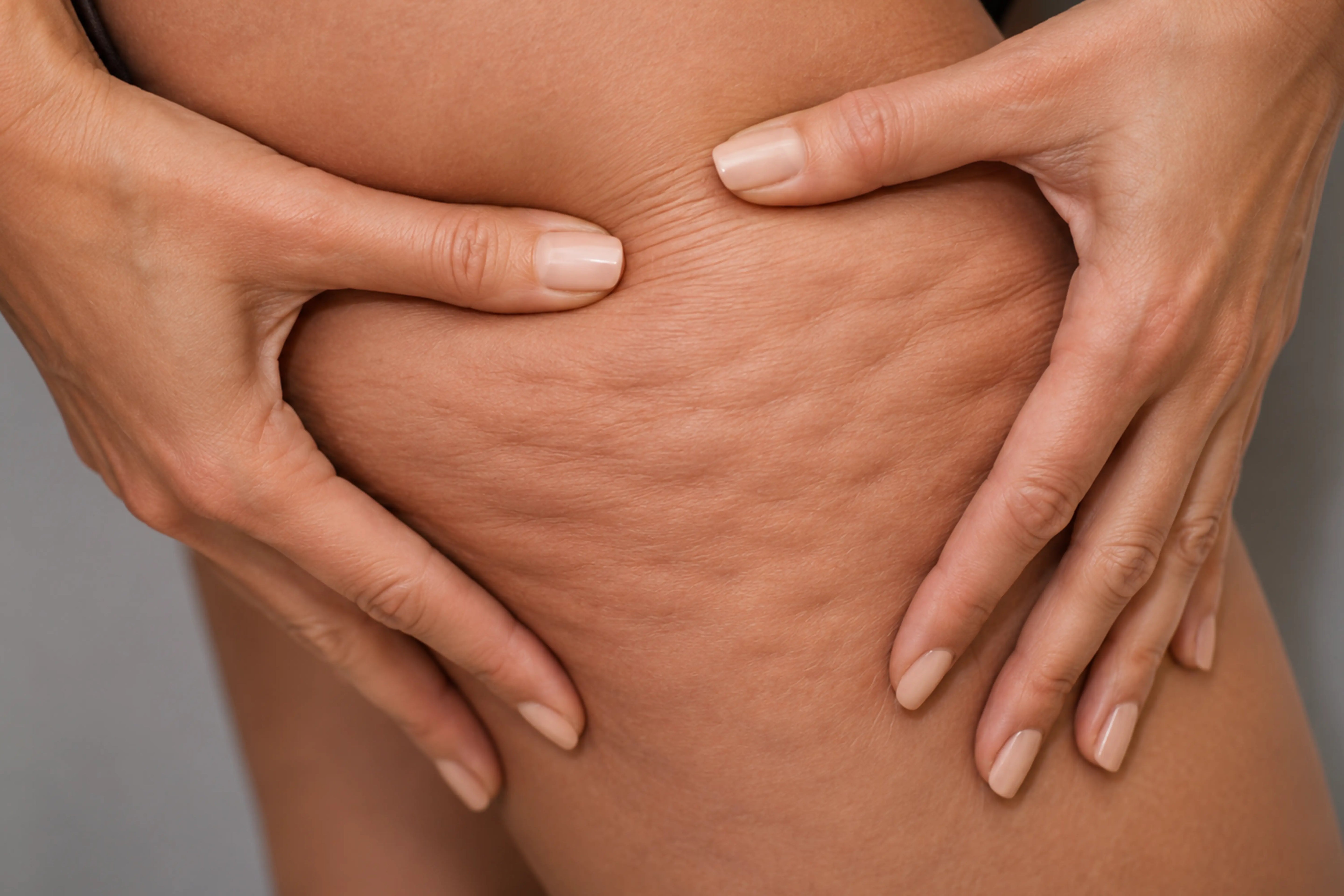 ¿Cómo puedo reducir la celulitis? Hábitos y tratamientos