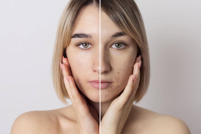 causas del acne